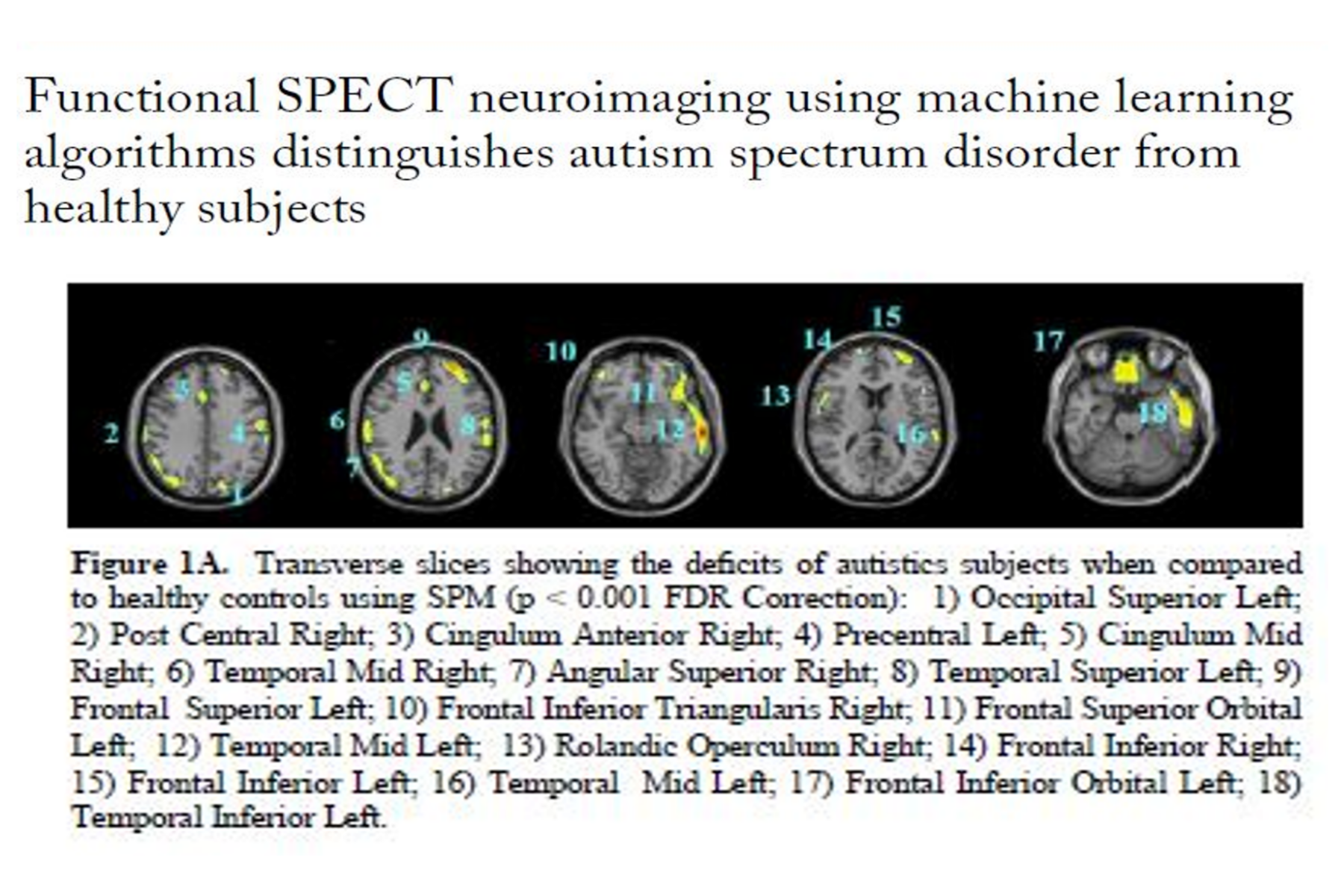 MACHINE LEARNING IN AUTISM SPECTRUM DISORDER