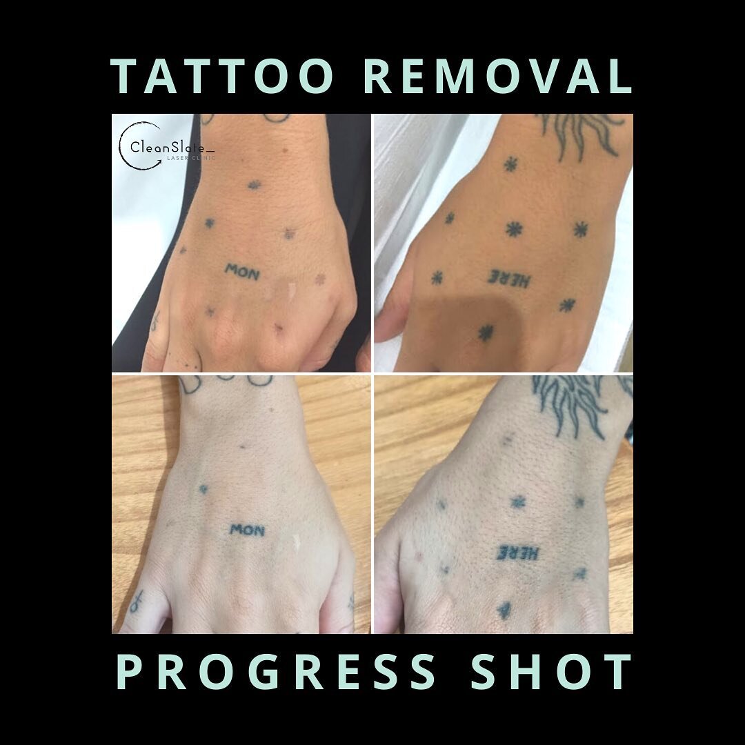 Another very happy client! Check out this progress shot @cleanslatebali 🙌🏼 2 treatments of Laser Tattoo Removal - 1 year apart 🤩 &mdash;&mdash;&gt; the body starts to gradually dissolve the ink once you start with your 1st treatment! 
.
⭐️ to lear