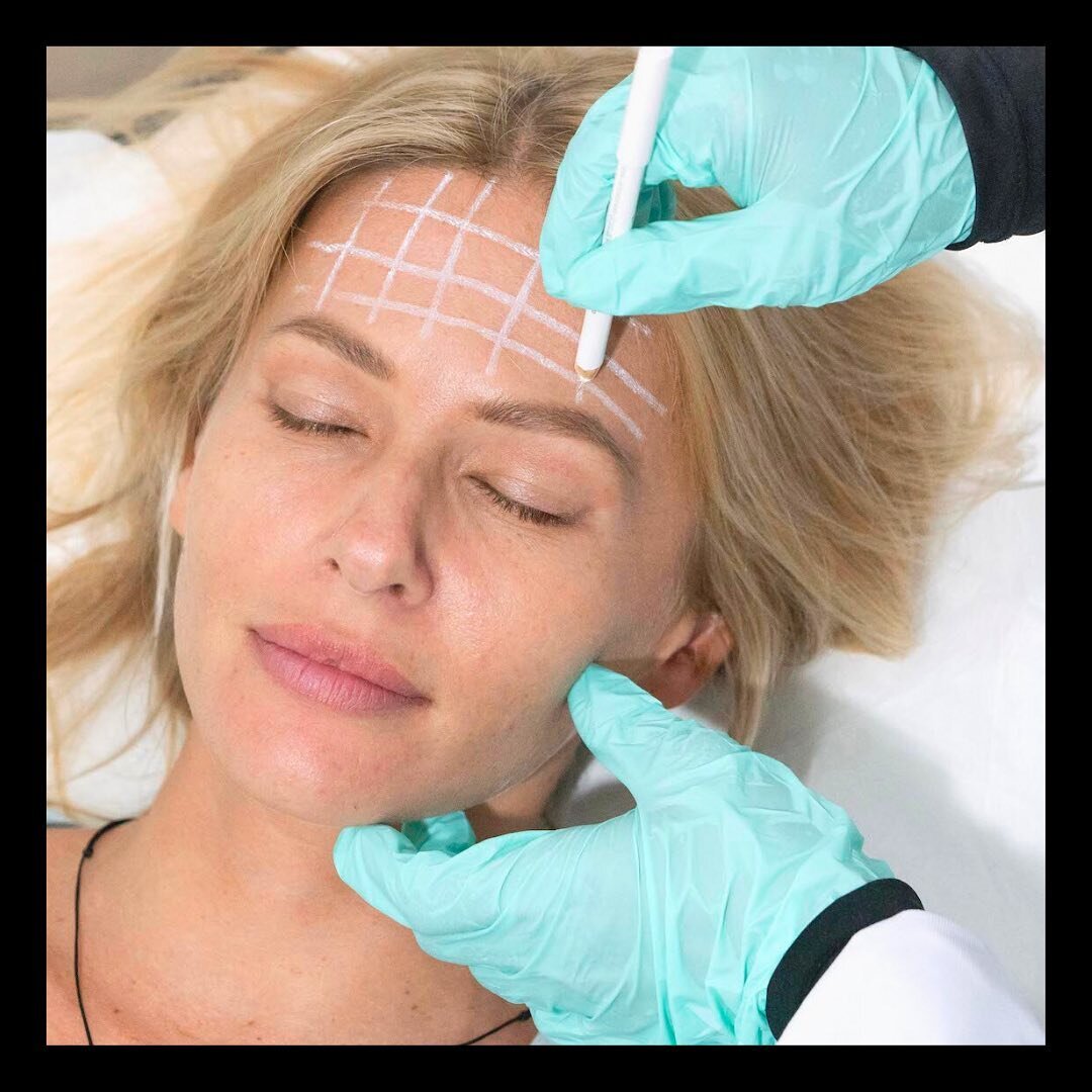 Is 'Preventative' Botox in Your 20s and 30s worth the hype? 🤔
.
⭐️YES &mdash;-&gt; Using Botox can reverse mild lines and prevent them from developing at all. 
.
The best time to start treating wrinkles is when they first appear. Initially wrinkles 