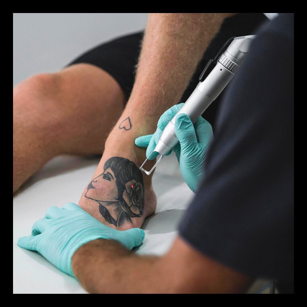 ⭐️ Laser tattoo removal is considered one of the most convenient and popular methods for erasing tattoos. In fact, over the past decade, the number of laser tattoo removal clinics in the U.S. has grown by over 400%. 
.
⭐️ Laser Tattoo Removal is a Sa