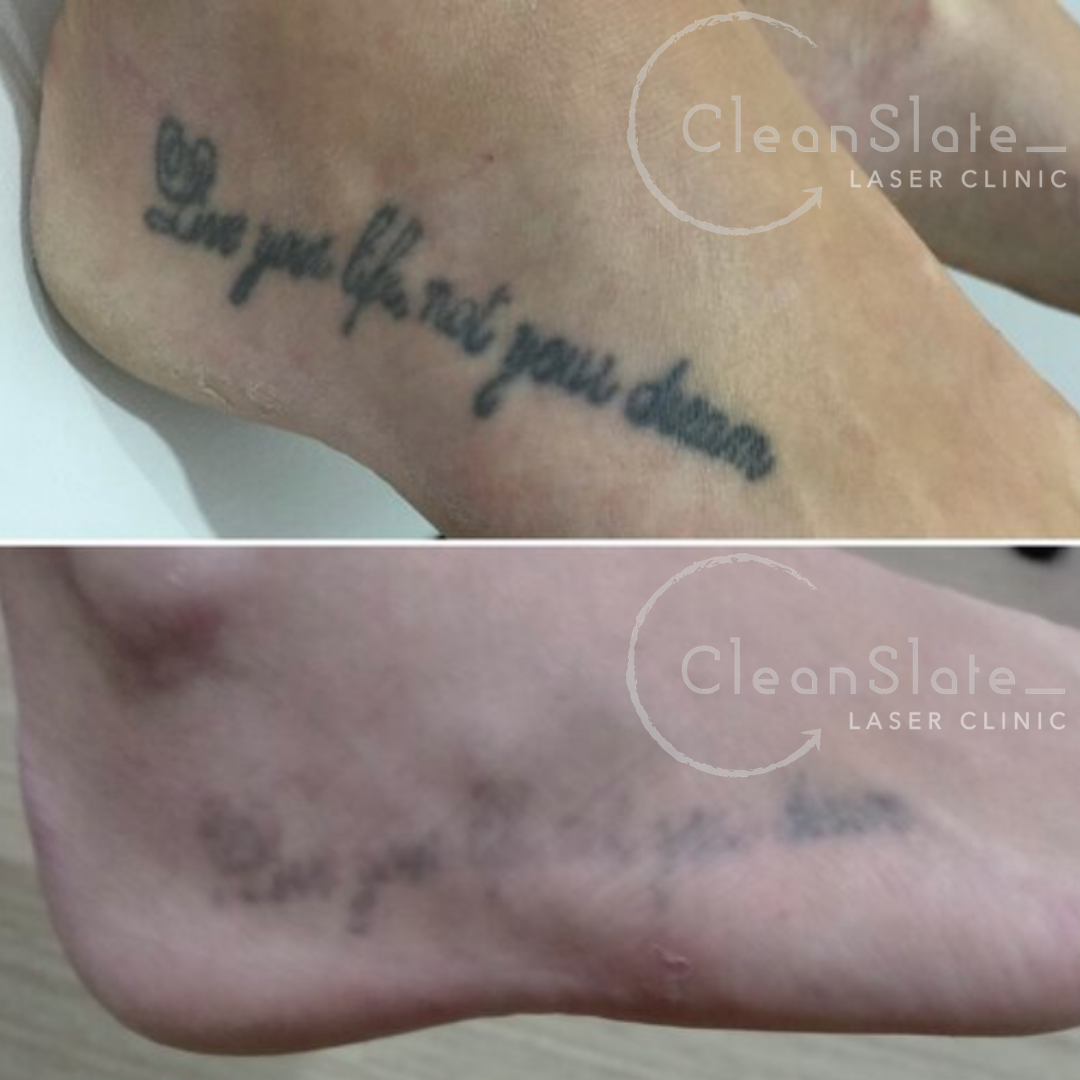 Tattoo Removal Bali