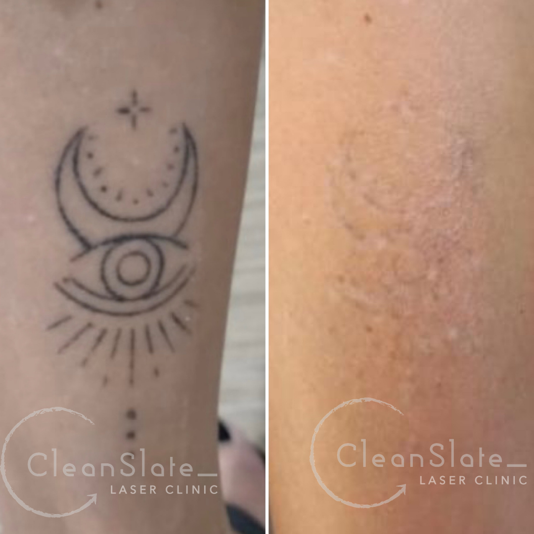 Tattoo Removal Bali