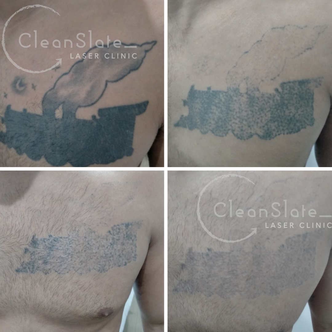 Laser Tattoo Removal No Blisters