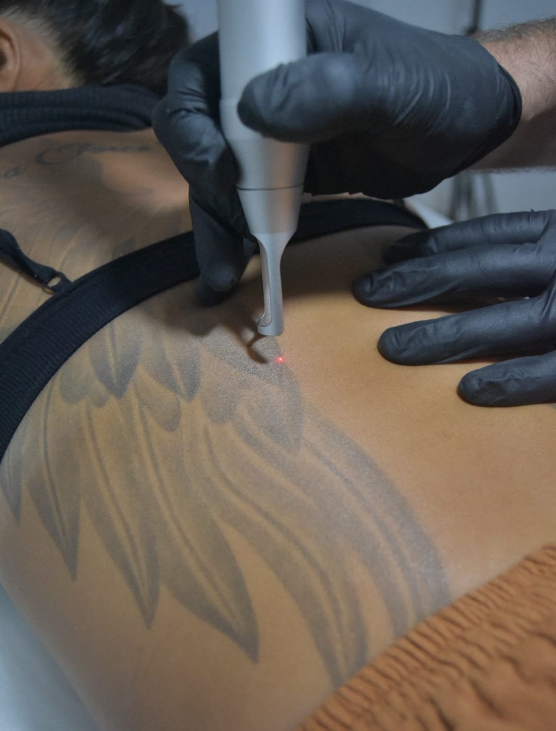 Does Tattoo Removal Leave Scars  Prevention and Treatment