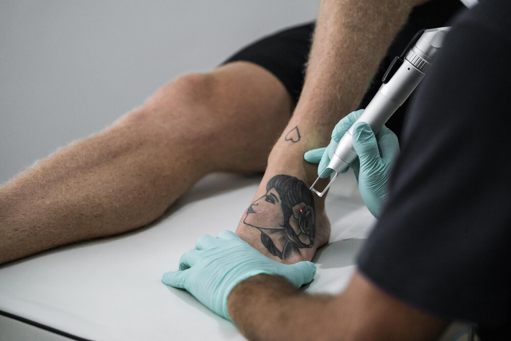 Tattoo Removal | Luxe Laser Center
