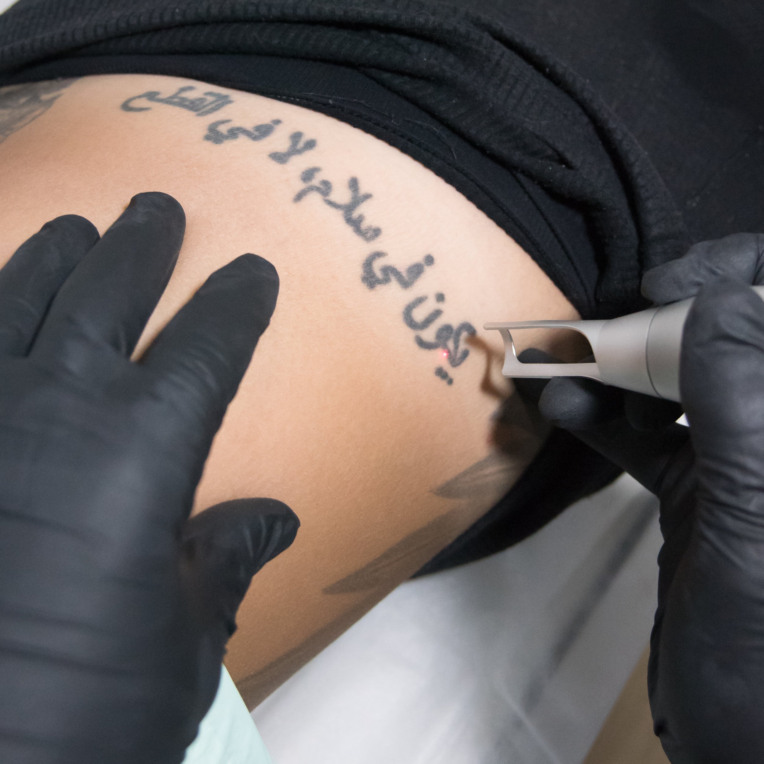 Top Factors That Affect A Laser Tattoo Removal Progress