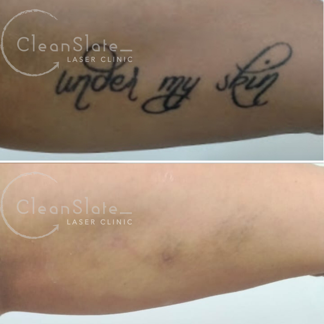 Clean slate tattoo - gaswnot
