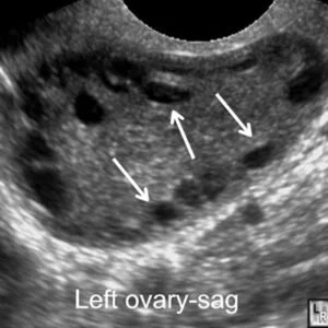 The Difference Between PCO And PCOS: Learn How To Get The Diagnosis You ...