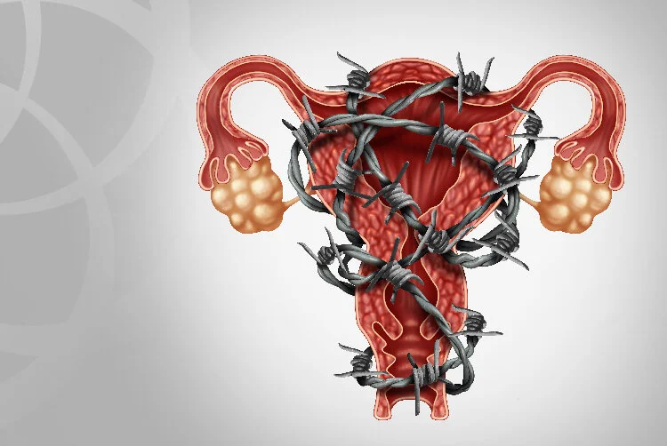 What Does Endometriosis Pain Feel Like? 3 Artists Share Their Struggles