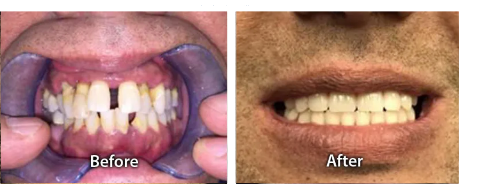 New Teeth Chicago Dental Implants