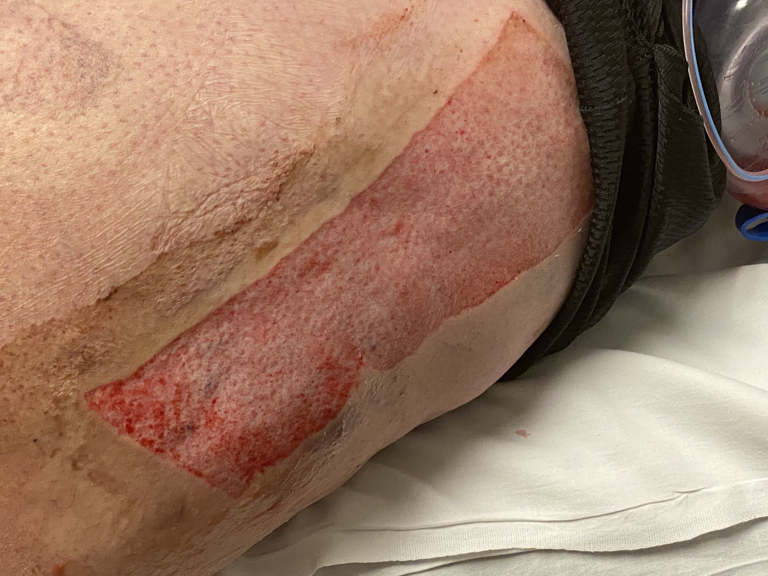 Skabelse Krigsfanger Prøve Skin Grafts in the ER? Part I, in a series of graft care in the ER — The  Proceduralist
