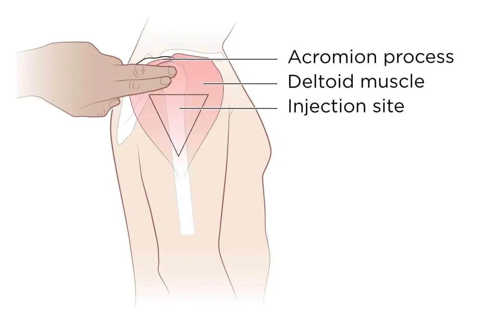 Muscles Contract Injection Intramusclar Injections: 101 — The Proceduralist
