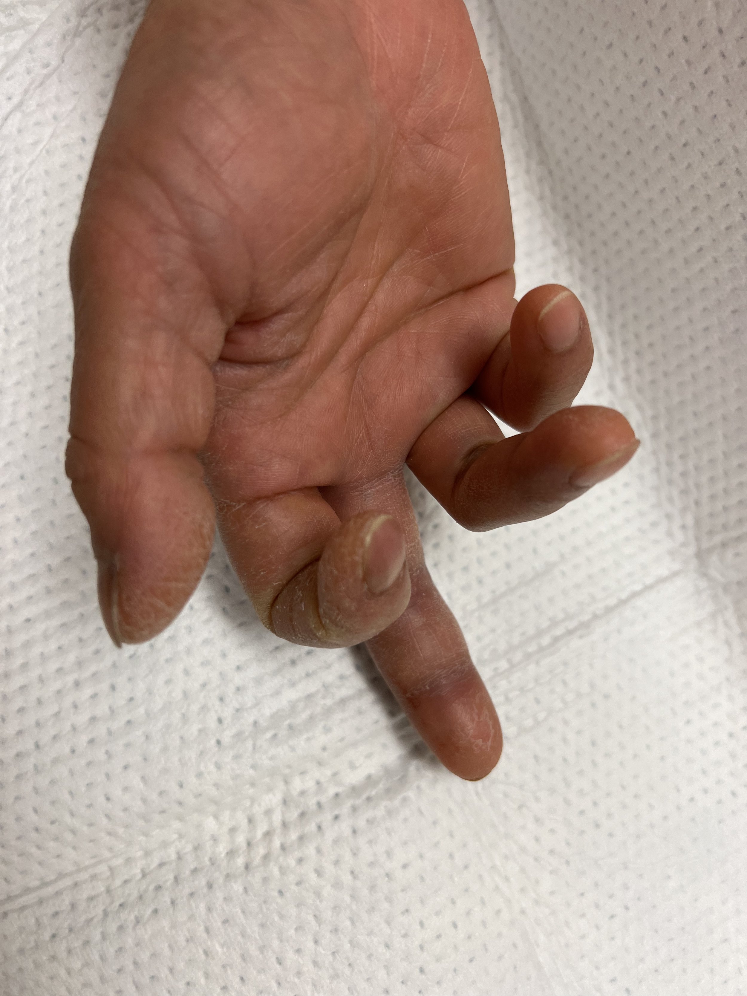 Infected Hangnail: Signs, Treatment, and Prevention