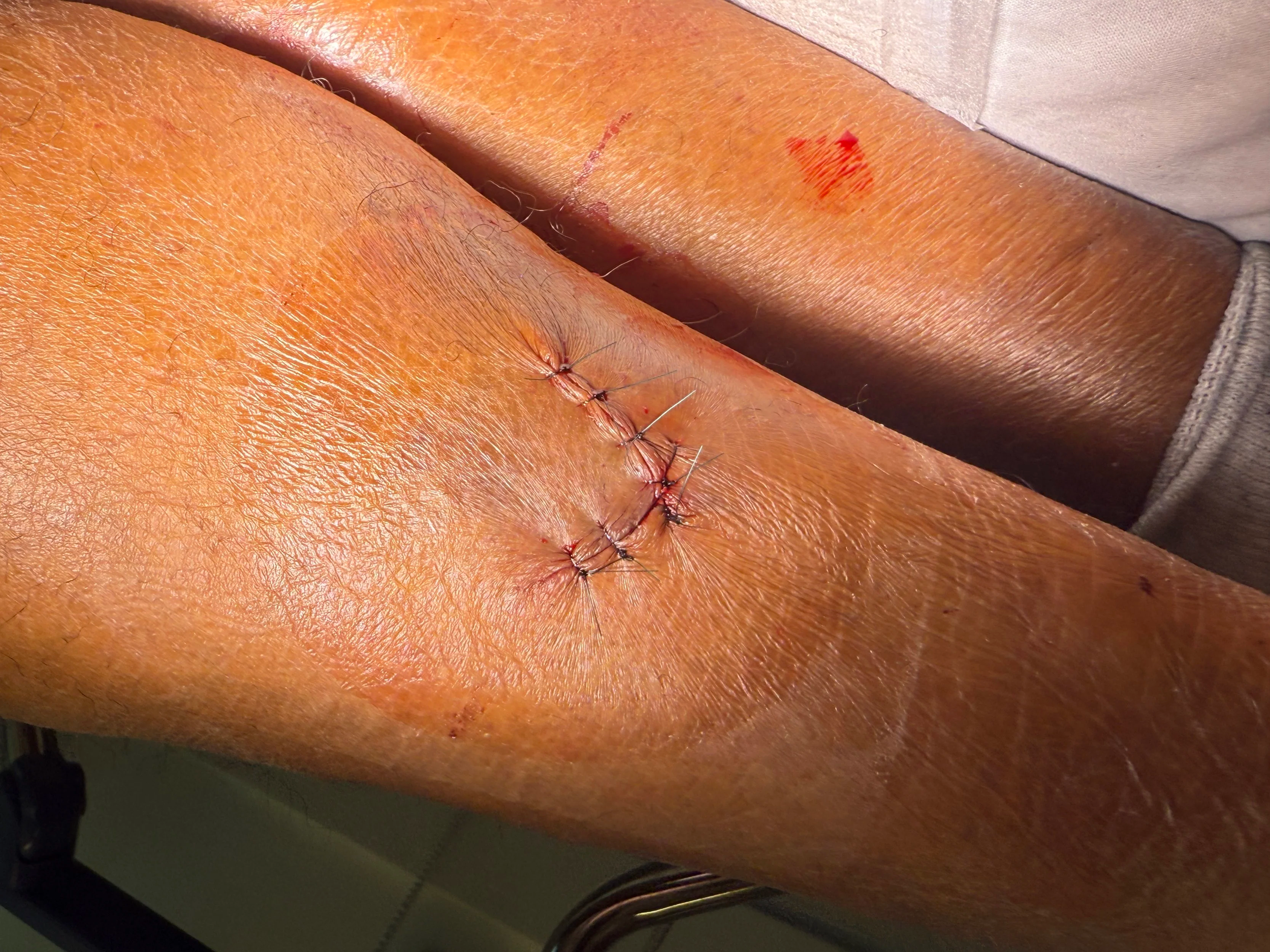 Lower Extremity Wounds and Flap Closure Techniques