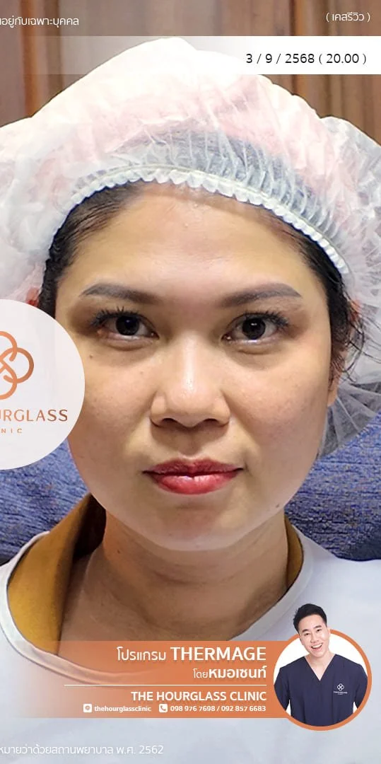 ผลลัพธ์หลังทำทันที Thermage FLX โดยหมอเซนท์ The Hourglass Clinic  แสดงใบหน้าที่ยกกระชับ กรอบหน้าที่ชัดมากขึ้น รอยพับร่องแก้ม ร่องน้ำหมากที่จางลงอย่างเห็นได้ชัด
