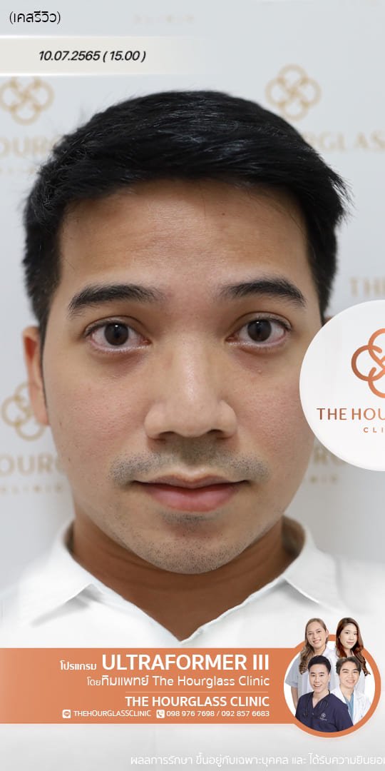 รีวิวก่อนทำ Ultraformer III เพื่อยกกระชับหน้าและปรับรูปหน้าให้คมชัด โดยทีมแพทย์ The Hourglass Clinic