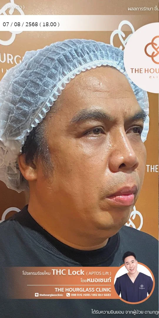 รีวิว ร้อยไหม APTOS ก่อนทำ หมอเซนท์​ The Hourglass Clinic