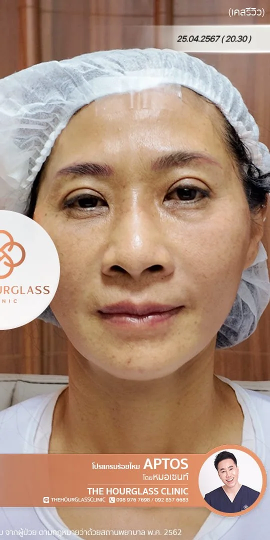 ภาพรีวิว หลังการร้อยไหมโปรแกรม APTOS Lift (After) ทันที แสดงให้เห็นกรอบหน้าที่คมชัดขึ้น ใบหน้ายกกระชับ และดูเรียวเป็น V-Shape มากขึ้นอย่างเห็นได้ชัด