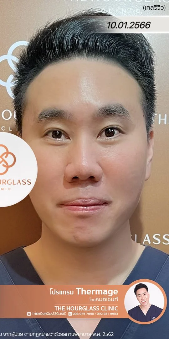 ผลลัพธ์หลังทำทันที Thermage FLX โดยหมอเซนท์ The Hourglass Clinic  แสดงใบหน้าที่ยกกระชับ ผิวดูสดใส อ่อนเยาว์ อย่างเห็นได้ชัด