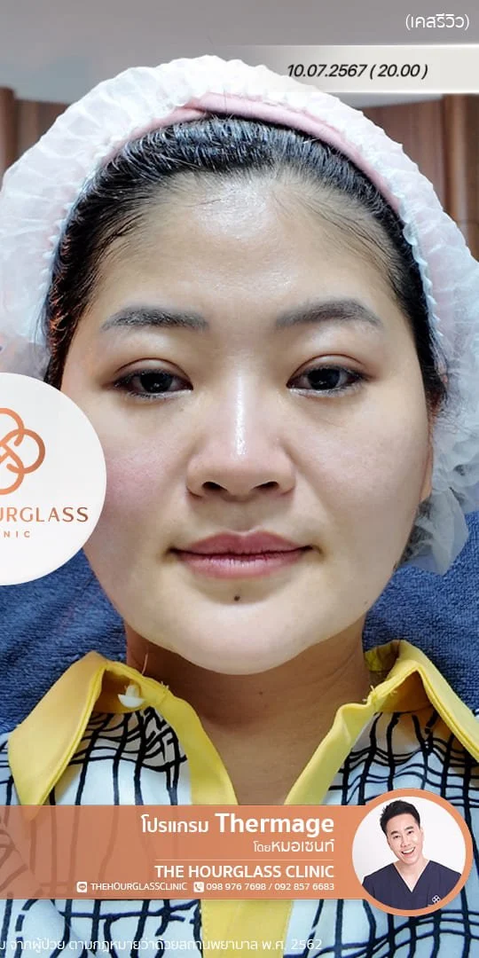 ผลลัพธ์หลังทำทันที Thermage FLX โดยหมอเซนท์ The Hourglass Clinic  แสดงใบหน้าที่ยกกระชับ ร่องแก้มดูจางลง อย่างเห็นได้ชัด