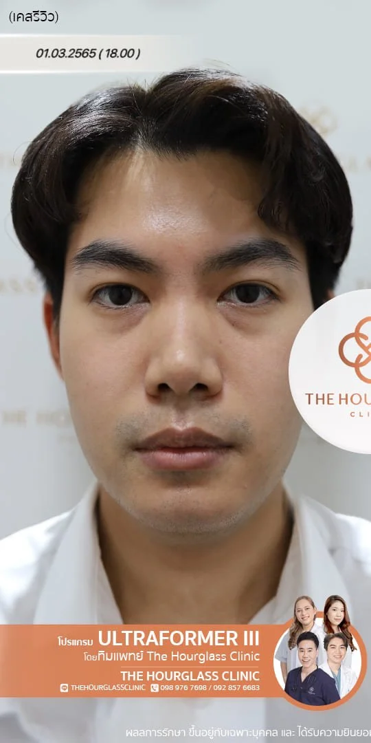 รีวิวก่อนทำ Ultraformer III เพื่อยกกระชับหน้าและปรับรูปหน้าให้คมชัด โดยทีมแพทย์ The Hourglass Clinic