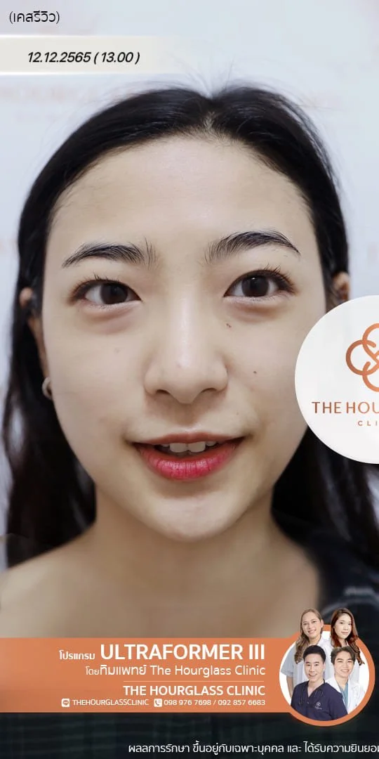 รีวิวก่อนทำ Ultraformer III เพื่อยกกระชับหน้าและปรับรูปหน้าให้คมชัด โดยทีมแพทย์ The Hourglass Clinic