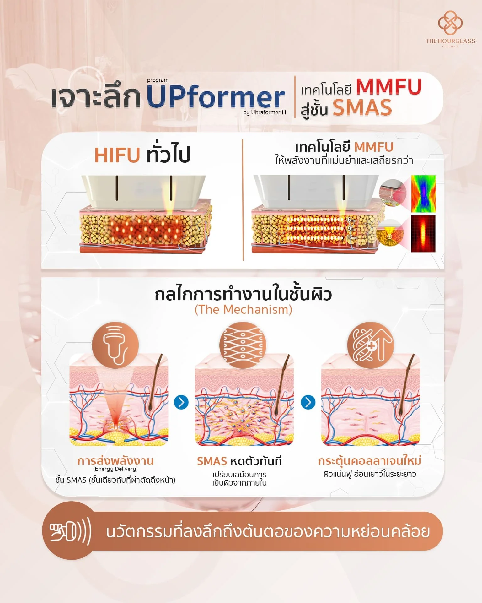 อินโฟกราฟิกเจาะลึกการทำงานของ Ultraformer III (โปรแกรม UPformer) ด้วยเทคโนโลยี MMFU เปรียบเทียบกับ HIFU ทั่วไป แสดงกลไกในผิว 3 ขั้นตอน: 1. การส่งพลังงาน MMFU สู่ชั้น SMAS 2. SMAS หดตัวทันที 3. กระตุ้นสร้างคอลลาเจนใหม่ เพื่อการยกกระชับที่ล้ำลึกจาก