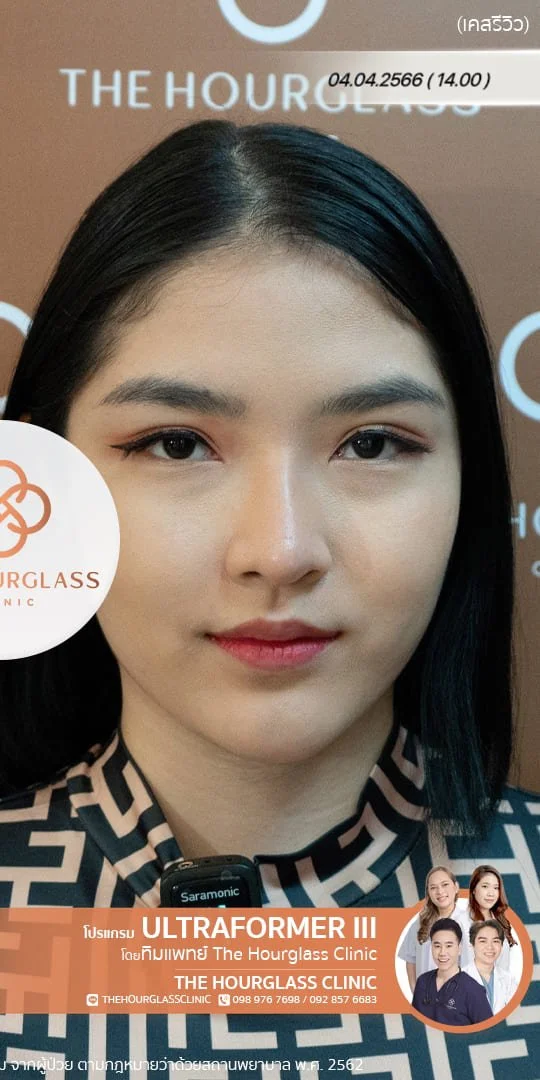รีวิวหลังทำ Ultraformer III ทันที ช่วยยกกระชับกรอบหน้า ปรับหน้าเรียว V-Shape และลดความหย่อนคล้อย ที่ The Hourglass Clinic