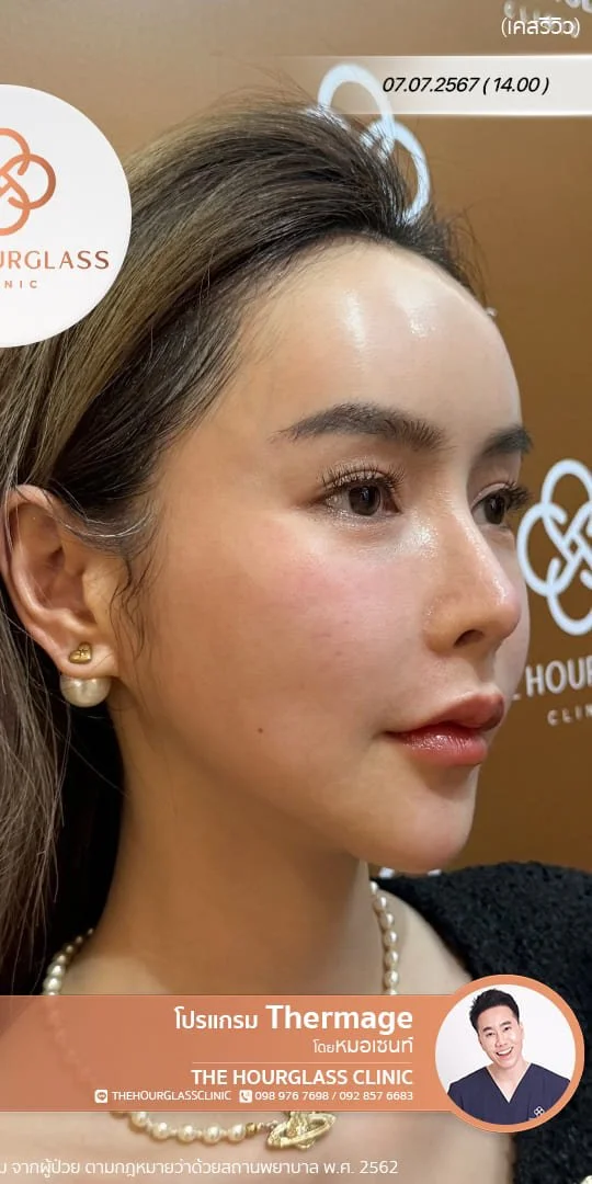 ผลลัพธ์หลังทำทันที Thermage FLX โดยหมอเซนท์ The Hourglass Clinic  แสดงใบหน้าที่ยกกระชับ กรอบหน้าที่ชัดมากขึ้น อย่างเห็นได้ชัด
