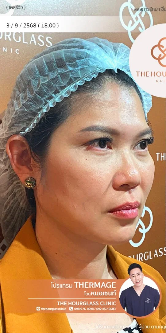 รีวิวก่อนทำ Thermage FLX เพื่อแก้ไขปัญหาผิวหย่อนคล้อยและกรอบหน้าไม่ชัดเจน เคสหมอเซนท์ The Hourglass Clinic  แสดงลักษณะผิวที่ขาดความกระชับก่อนรับบริการ
