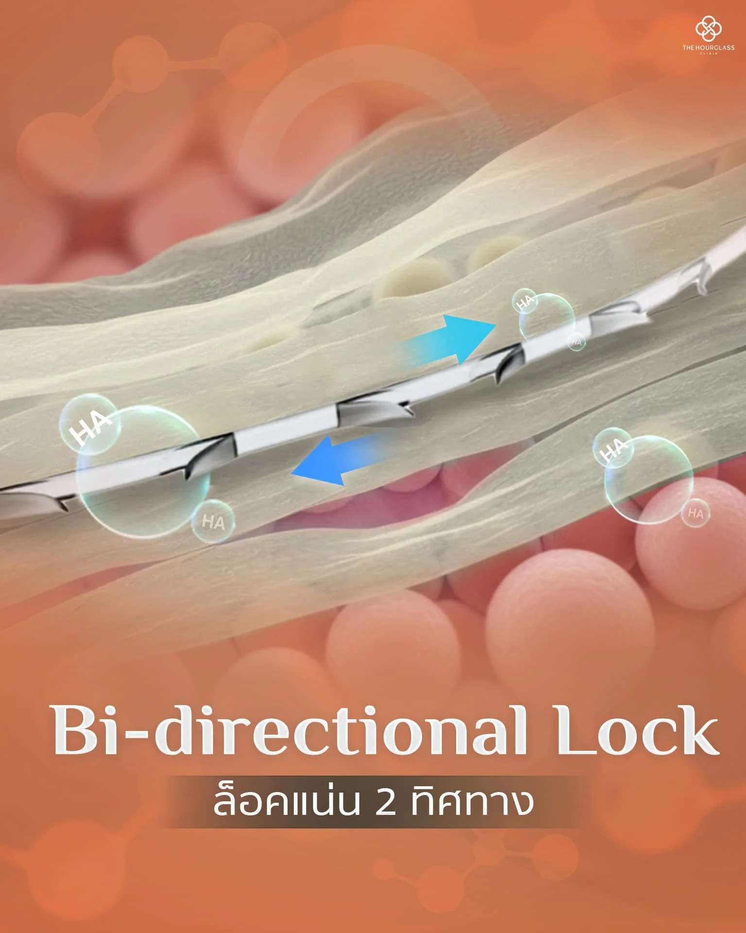 ภาพจำลองระบบล็อคไหมสองทิศทาง (Bi-directional Lock) ที่ยึดเกาะชั้นพังผืด SMAS (Layer 4) และก้อนไขมันชั้นตื้นอย่างแน่นหนา มั่นคง ทนต่อการแสดงสีหน้า และป้องกันไหมรูดหรือหน้ากลับมาคล้อยไว