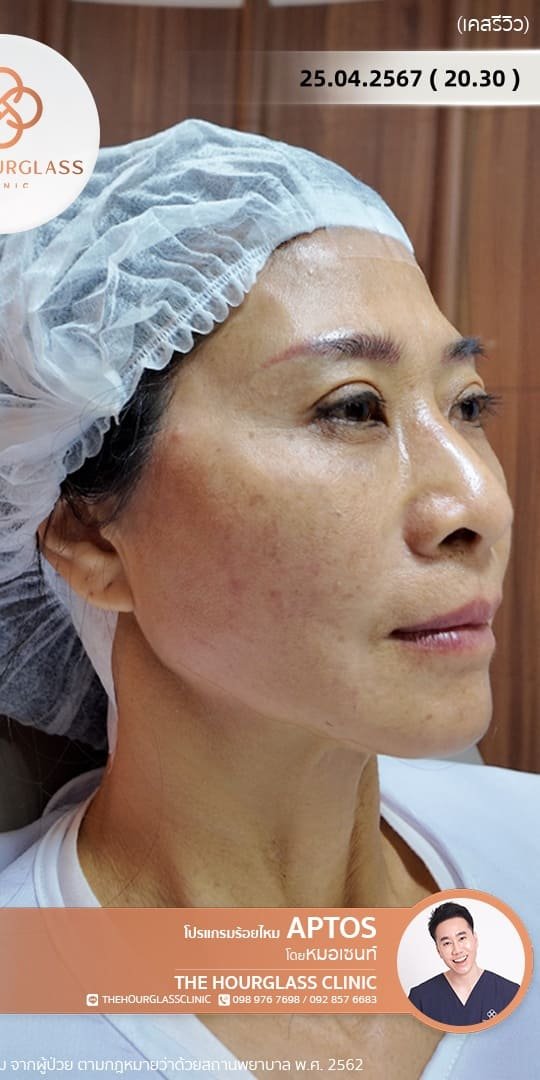 ภาพรีวิว หลังการร้อยไหมโปรแกรม APTOS Lift (After) ทันที แสดงให้เห็นกรอบหน้าที่คมชัดขึ้น ใบหน้ายกกระชับ และดูเรียวเป็น V-Shape มากขึ้นอย่างเห็นได้ชัด