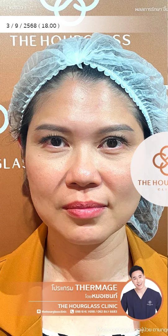 รีวิวก่อนทำ Thermage FLX เพื่อแก้ไขปัญหาผิวหย่อนคล้อยและกรอบหน้าไม่ชัดเจน เคสหมอเซนท์ The Hourglass Clinic  แสดงลักษณะผิวที่ขาดความกระชับก่อนรับบริการ