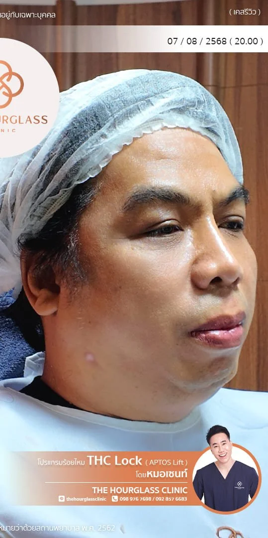 รีวิว ร้อยไหม APTOS หลังทำ ทันทีหมอเซนท์​ The Hourglass Clinic