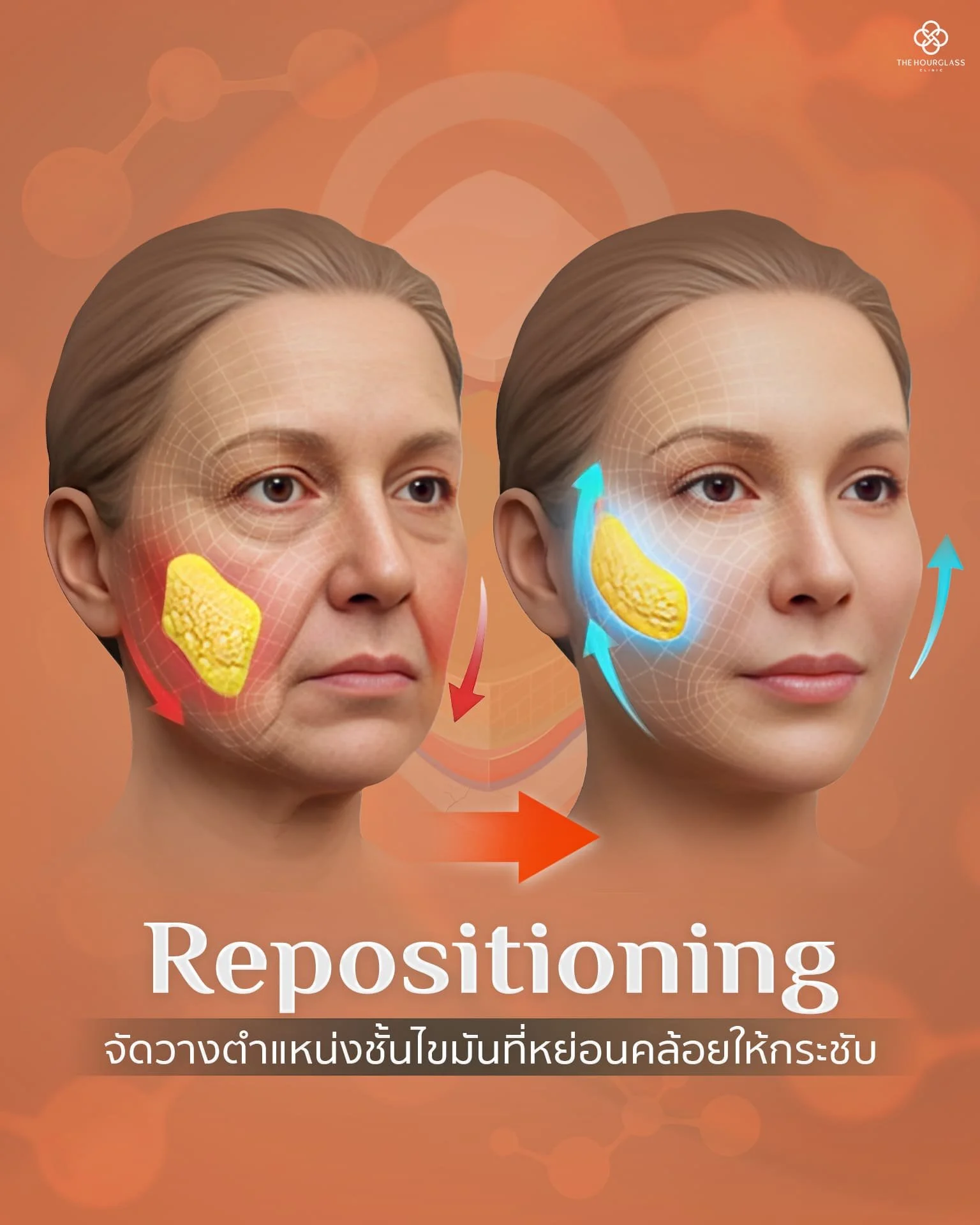 กราฟิกเปรียบเทียบการจัดวางตำแหน่งไขมันใหม่ (Structural Repositioning) ย้ายก้อนไขมันที่หย่อนคล้อยให้กลับคืนตำแหน่งเดิมตามธรรมชาติ แก้ไขปัญหาร่องแก้มลึกและแก้มห้อยจากต้นเหตุโดยไม่ต้องพึ่งฟิลเลอร์