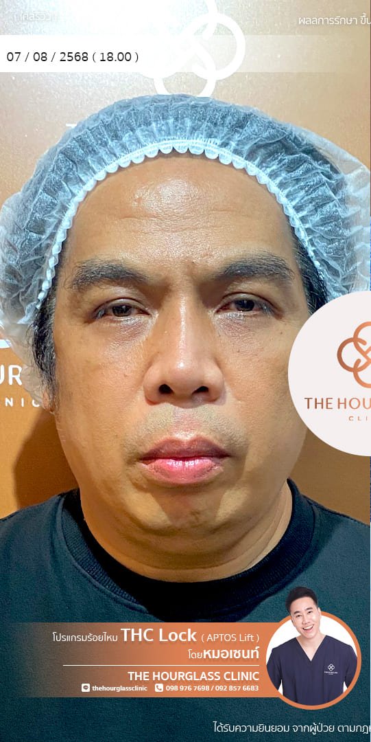 รีวิว ร้อยไหม APTOS ก่อนทำ หมอเซนท์​ The Hourglass Clinic