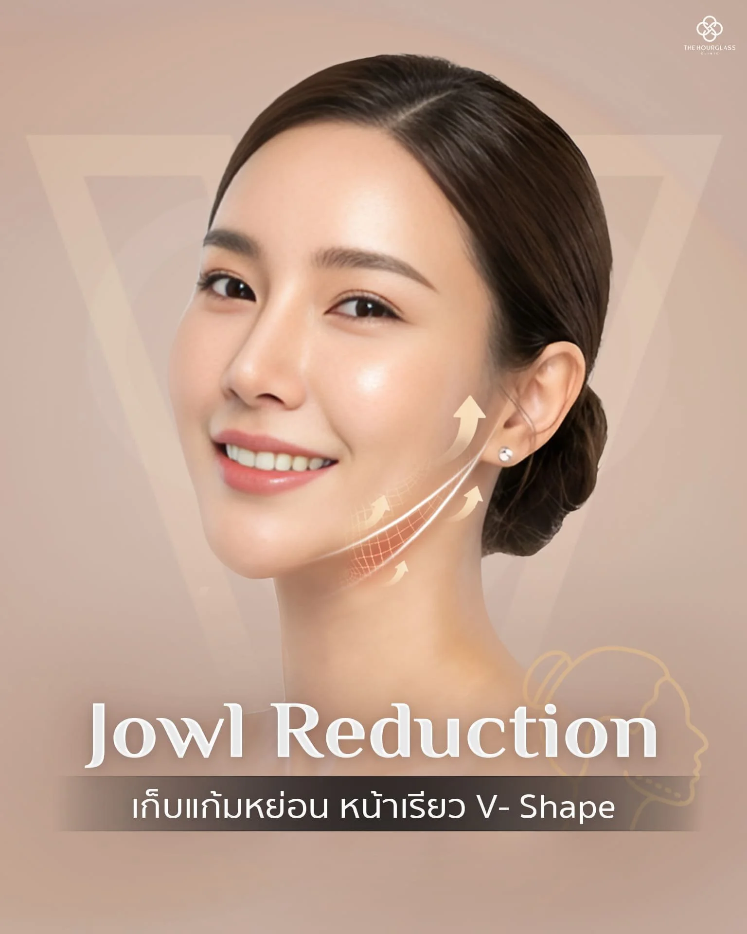 ภาพจำลองเทคนิค THC Lock ในการร้อยไหม V-Lift เพื่อเก็บเหนียงและลดแก้มห้อย โดยการจัดวางตำแหน่งก้อนไขมันใหม่ให้กรอบหน้าชัด