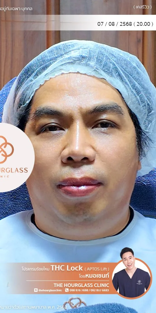 รีวิว ร้อยไหม APTOS หลังทำ ทันทีหมอเซนท์​ The Hourglass Clinic