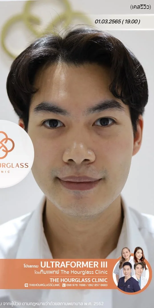 รีวิวหลังทำ Ultraformer III ทันที ช่วยยกกระชับกรอบหน้า ปรับหน้าเรียว V-Shape และลดความหย่อนคล้อย ที่ The Hourglass Clinic