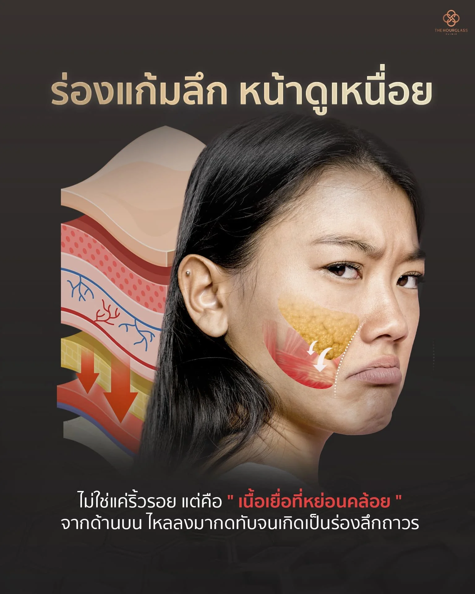สาเหตุของร่องแก้มลึกถาวรที่เกิดจากเนื้อเยื่อส่วนบนหย่อนคล้อยลงมากดทับ (Tissue Compression) ไม่ใช่แค่ริ้วรอยทั่วไป วิเคราะห์ปัญหาเชิงลึกเพื่อการยกกระชับที่ตรงจุดโดยทีมแพทย์ The Hourglass Clinic