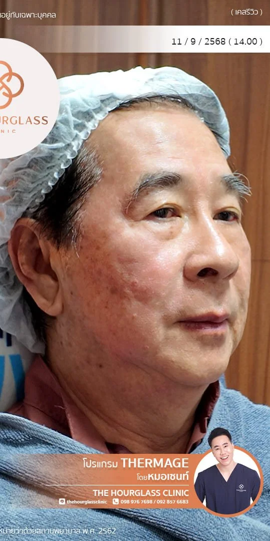 ผลลัพธ์หลังทำทันที Thermage FLX  โดยหมอเซนท์ The Hourglass Clinic  แสดงใบหน้าที่ยกกระชับ กรอบหน้าคมชัด และผิวแน่นอิ่มฟูขึ้นอย่างเห็นได้ชัด