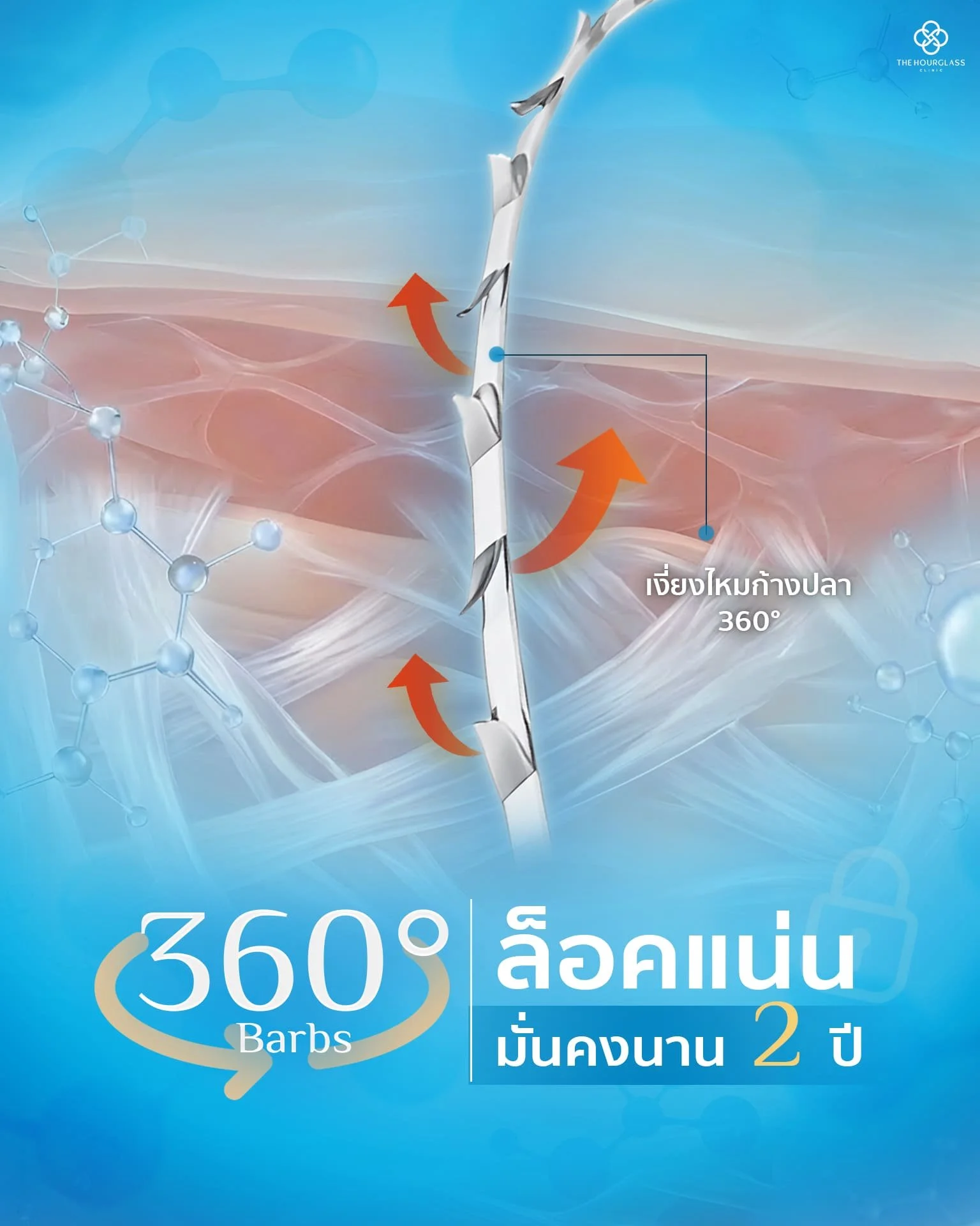ภาพขยายเงี่ยงไหม APTOS แบบ Multidirectional 360 องศา แสดงกลไกการล็อคชั้นพังผืด SMAS (Layer 4) และการย้ายตำแหน่งก้อนไขมันอย่างมั่นคง ให้ผลลัพธ์การยกกระชับยาวนาน 1.5 - 2 ปี