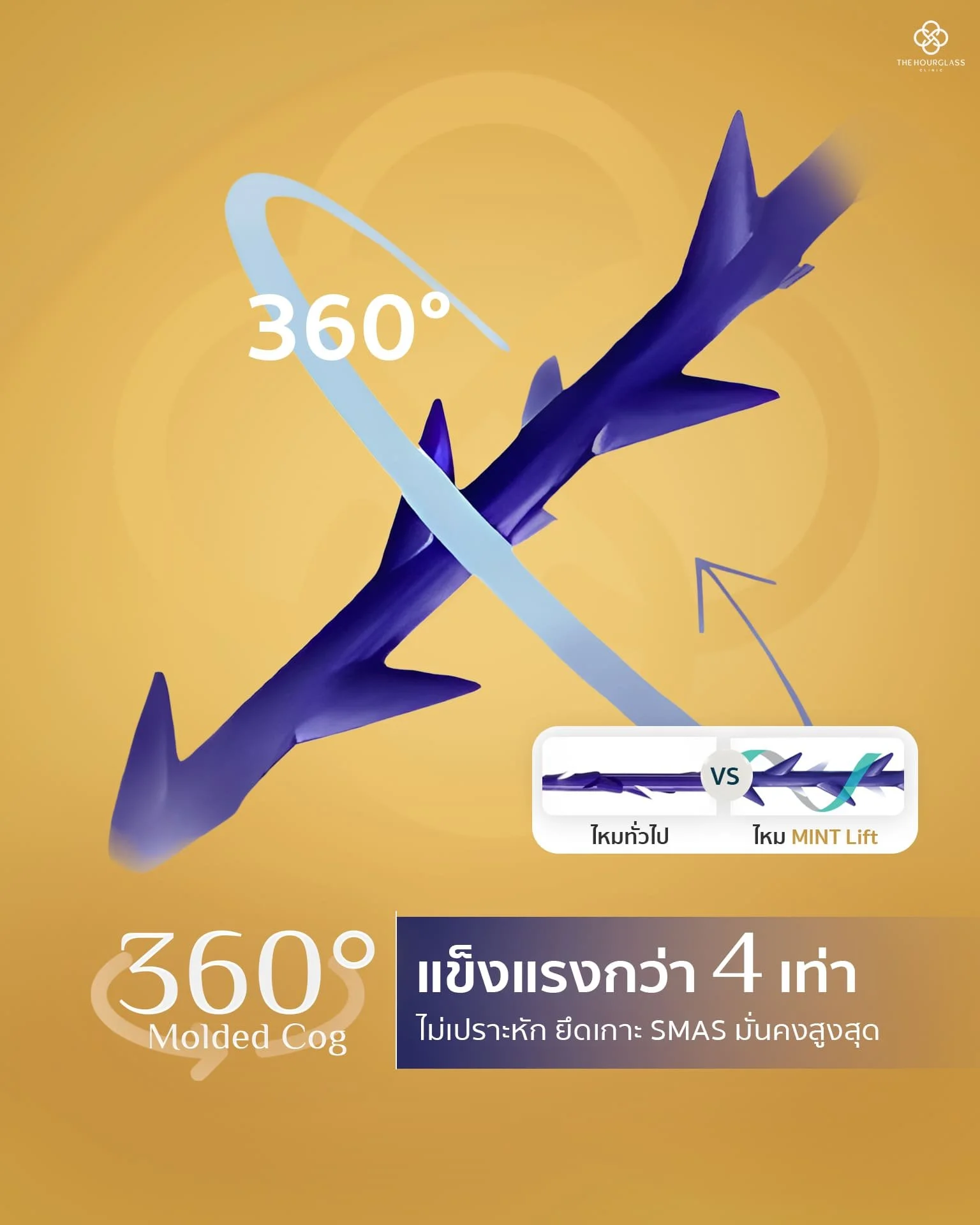 เจาะลึกจุดเด่นไหม MINT Lift เทคโนโลยี 360° Helical Molded Cog พลังเงี่ยงหล่อรอบทิศทาง แข็งแรงกว่าไหมเงี่ยงทั่วไป (Cutting) 4 เท่า ไม่เปราะหักง่าย และยึดเกาะชั้นผิว SMAS ได้แน่นหนากว่าไหมทั่วไป ที่ The Hourglass Clinic