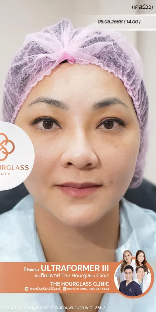 รีวิวหลังทำ Ultraformer III ทันที ช่วยยกกระชับกรอบหน้า ปรับหน้าเรียว V-Shape และลดความหย่อนคล้อย ที่ The Hourglass Clinic