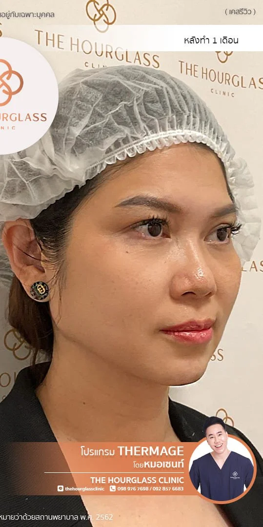 ผลลัพธ์หลังทำ 1 เดือน Thermage FLX โดยหมอเซนท์ The Hourglass Clinic  แสดงใบหน้าที่ยกกระชับ กรอบหน้าที่ชัดมากขึ้น รอยพับร่องแก้ม ร่องน้ำหมาก ร่องแก้ม ที่จางลงอย่างเห็นได้ชัด