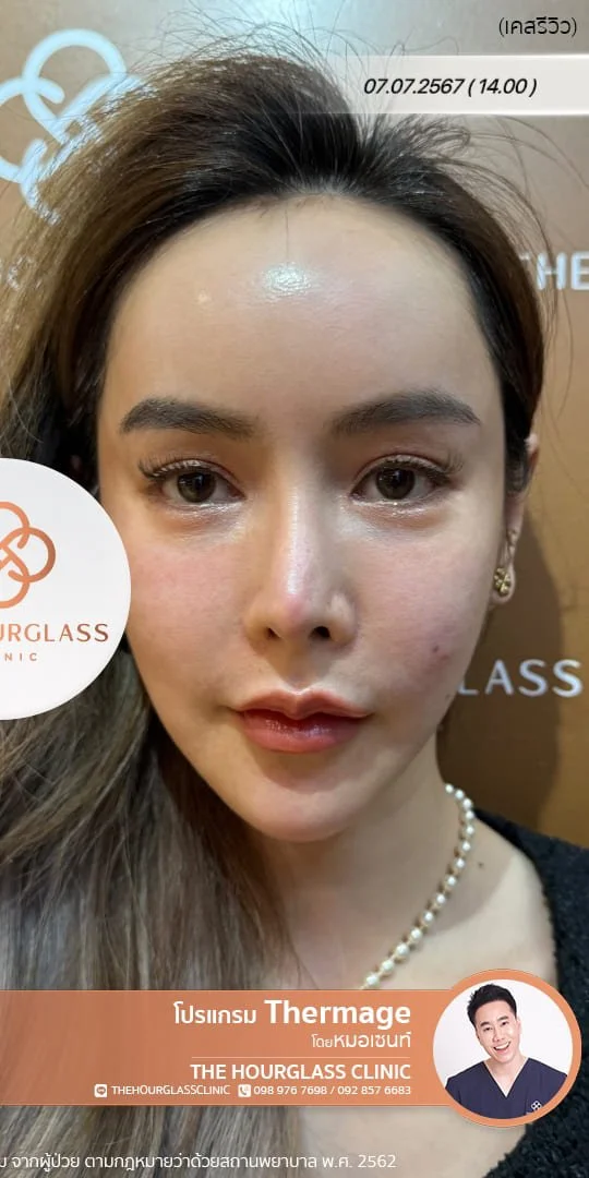ผลลัพธ์หลังทำทันที Thermage FLX โดยหมอเซนท์ The Hourglass Clinic  แสดงใบหน้าที่ยกกระชับ กรอบหน้าที่ชัดมากขึ้น อย่างเห็นได้ชัด