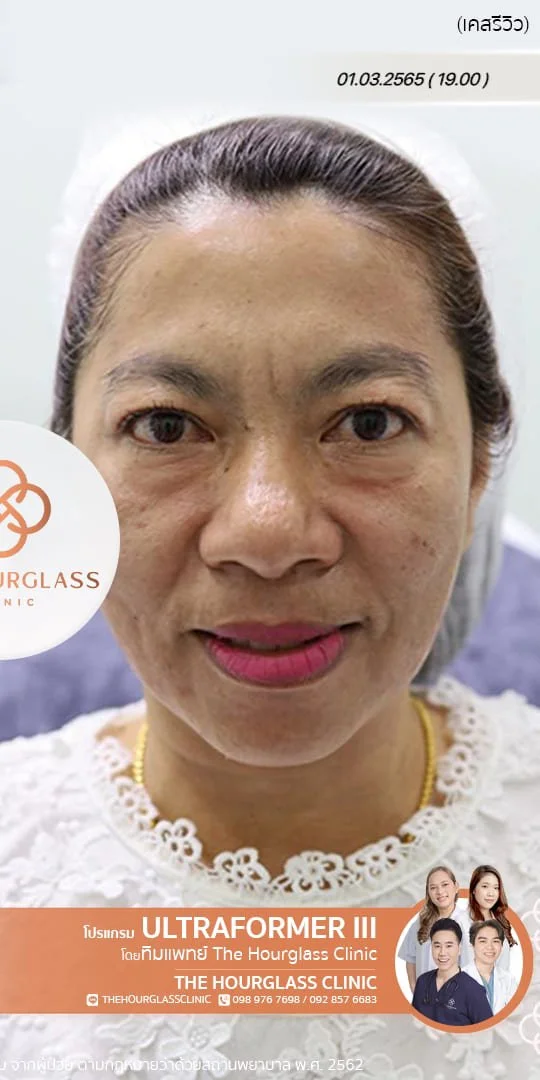 รีวิวหลังทำ Ultraformer III ทันที ช่วยยกกระชับกรอบหน้า ปรับหน้าเรียว V-Shape และลดความหย่อนคล้อย ที่ The Hourglass Clinic