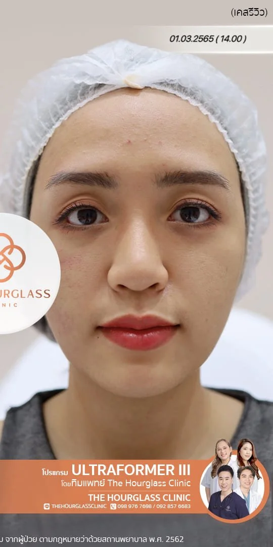 รีวิวหลังทำ Ultraformer III ทันที ช่วยยกกระชับกรอบหน้า ปรับหน้าเรียว V-Shape และลดความหย่อนคล้อย ที่ The Hourglass Clinic