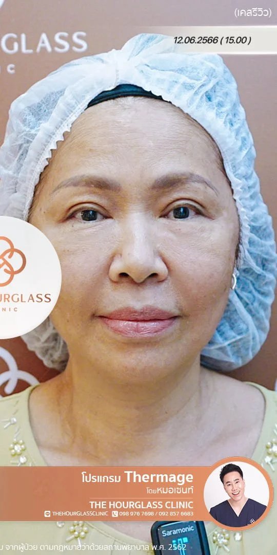 ผลลัพธ์หลังทำทันที Thermage FLX โดยหมอเซนท์ The Hourglass Clinic  แสดงใบหน้าที่ยกกระชับ ร่องแก้มดูจางลง อย่างเห็นได้ชัด