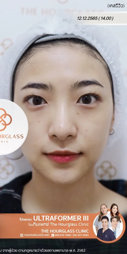 รีวิวหลังทำ Ultraformer III ทันที ช่วยยกกระชับกรอบหน้า ปรับหน้าเรียว V-Shape และลดความหย่อนคล้อย ที่ The Hourglass Clinic
